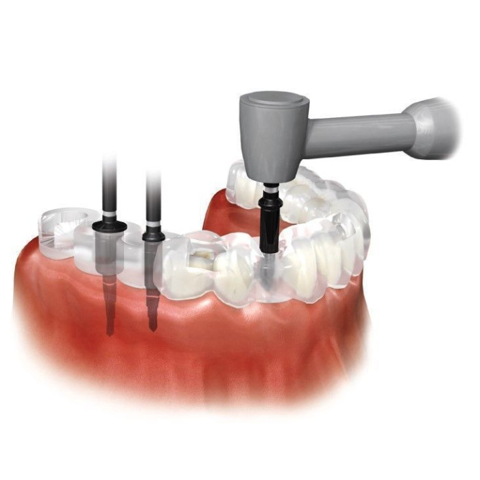 Гільза титанова № FMS49, 1шт (Dentium/Дентіум)