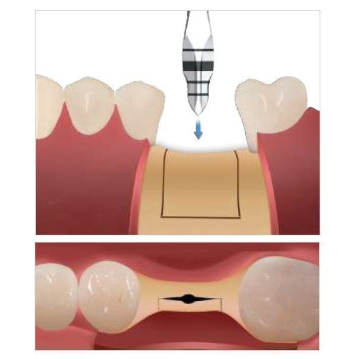 Долото кісткове RS-KIT (РС-Кіт) № XBC305013, 1шт (Dentium/Дентіум)