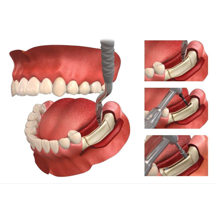 Набір для розщеплення RS-KIT (РС-Кіт) № XRSK, Н-р: 8інстр. (Dentium/Дентіум)