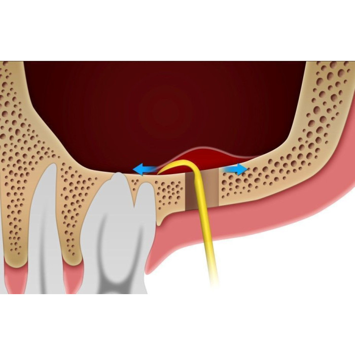 Кюрета DASK (ДАСК) № XSE3L, 1шт форма: середня (Dentium/Дентіум)