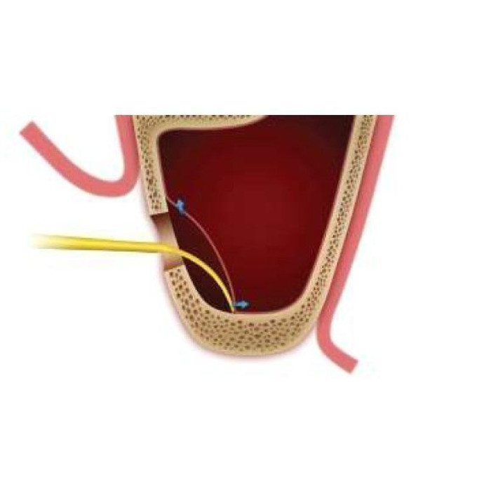 Кюрета DASK (ДАСК) № XSE4L, 1шт форма: великая (Dentium/Дентіум)