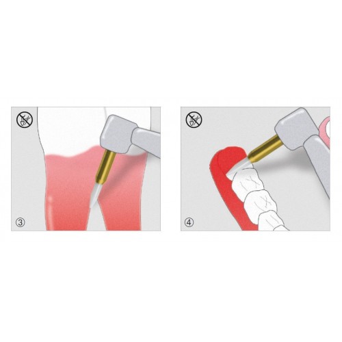 Trimmer Soft Tissue (Тріммер Софт Тіссу) № STT250.314.016, 1шт форма: голкоподібний; (L= 19 мм); діам.= 1.60 мм; роб.част.= 8.0 мм - Тріммер керамічний під ТН (Edenta/Едента) Trimmer Soft Tissue (Тріммер Софт Тіссу) № STT250.314.016, 1шт форма: голкоподібний; (L= 19 мм); діам.= 1.60 мм; роб.част.= 8.0 мм - Тріммер керамічний під ТН (Edenta/Едента)