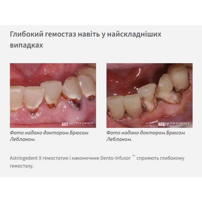 Astringedent X (Астриджидент Х) № 5881, шпр.1.2мл - Гемостатик-рідина (сульфат і субсульфат заліза 12.7%) (Ultradent/Ультрадент)