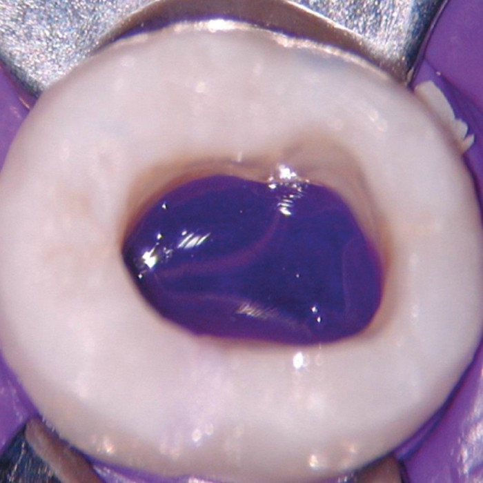 PermaFlo (ПермаФло) № 962-1, Блістер: шпр.1.2мл (Purple) (+1 нас.), (# ЗНЯТО З ВИРОБНИЦТВА  #) - Текучий композит, мікрогібридний (Ultradent/Ультрадент)