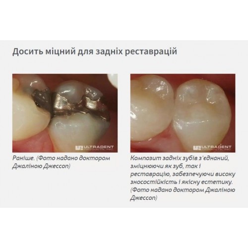 Amelogen Plus (Амелоген Плюс) № 9032, шпр.2.5г (A3), (# ЗНЯТО З ВИРОБНИЦТВА  #) - Реставраційний композит, мікрогібридний (Ultradent/Ультрадент)
