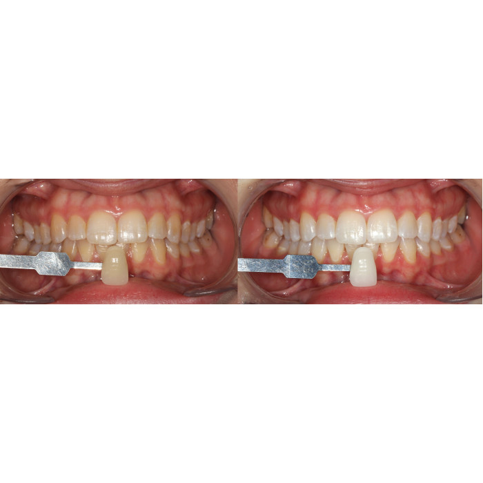 Opalescence Go 6%PF № 3592-EU, Н-р: 10компл. (смак: диня) (+зубна паста 28г) - Відбілюючі капи (перекис водню 6%) (Ultradent/Ультрадент)