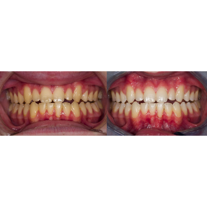 Opalescence Go 6%PF № 3592-EU, Н-р: 10компл. (смак: диня) (+зубна паста 28г) - Відбілюючі капи (перекис водню 6%) (Ultradent/Ультрадент)