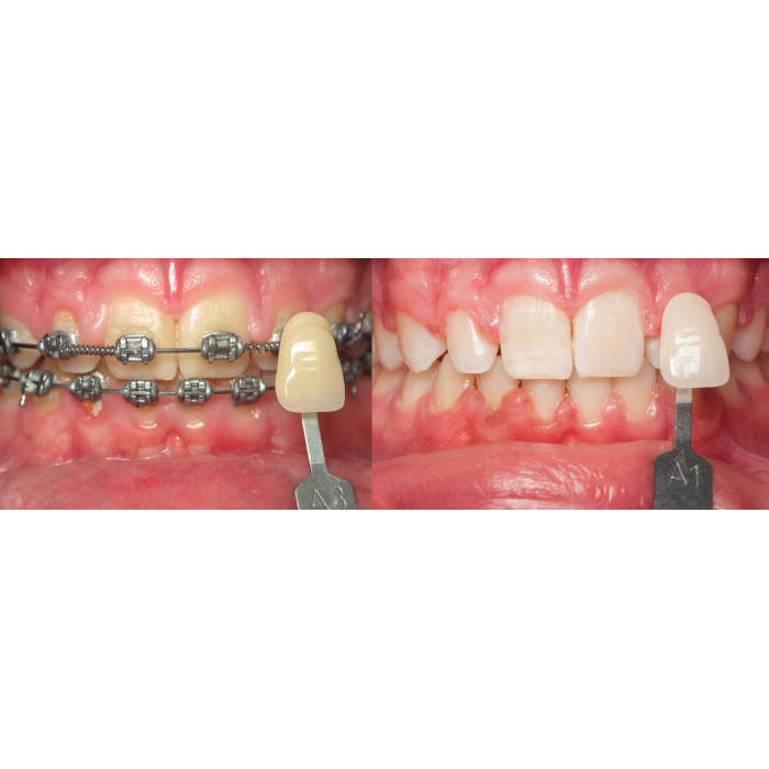 Opalescence Go 6%PF № 3592-EU, Н-р: 10компл. (смак: диня) (+зубна паста 28г) - Відбілюючі капи (перекис водню 6%) (Ultradent/Ультрадент)