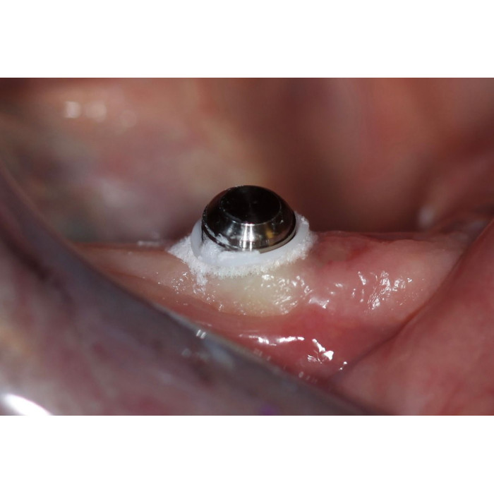 Гідроізолюючий гель OraSeal Putty (Орасіл Путті) № 353, 355, шпр.1.2мл (Ultradent/Ультрадент)