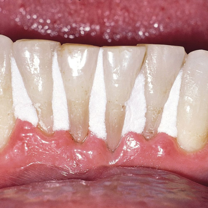 Гідроізолюючий гель OraSeal Putty (Орасіл Путті) № 353, 355, шпр.1.2мл (Ultradent/Ультрадент)