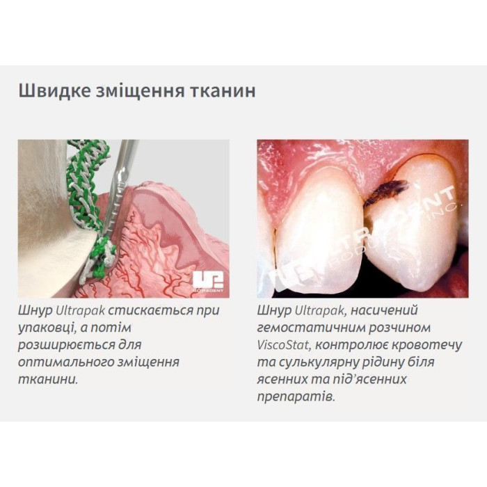 Ultrapak (Ультрапак) № 137, 1шт (довжина= 244 см; розм.= # 000) - Ретракційна нитка (без просочення) (Ultradent/Ультрадент)
