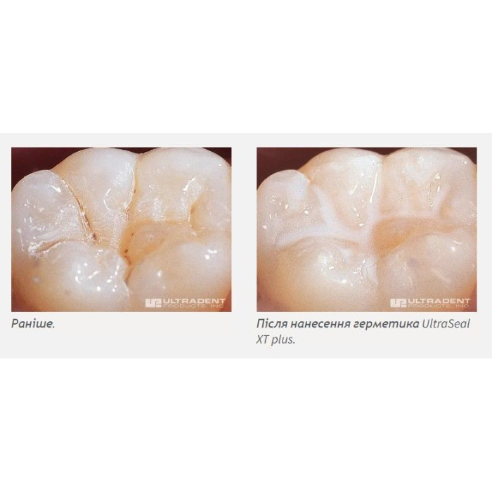 UltraSeal XT Plus (Ультрасіл Плюс) № 1289, шпр.1.2мл (A1) - Фісурний герметик (Ultradent/Ультрадент)