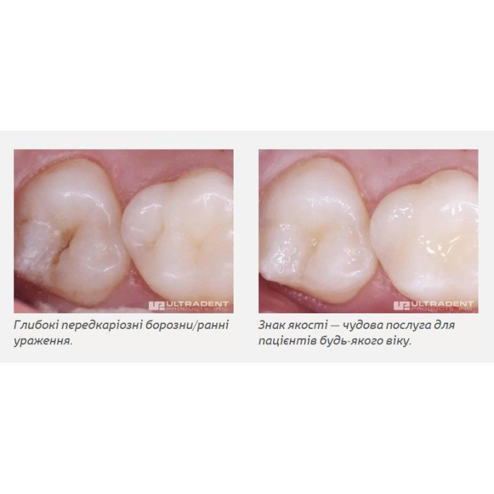 UltraSeal XT Plus (Ультрасіл Плюс) № 1289, шпр.1.2мл (A1) - Фісурний герметик (Ultradent/Ультрадент)