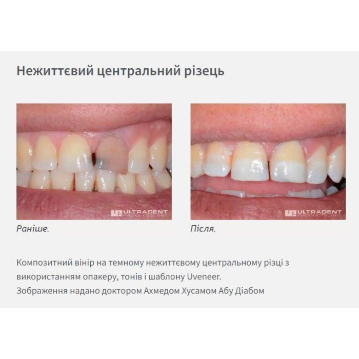 Uveneer (Ювенір) № UVKV3, Н-р: 4 х 8шт, (# ЗНЯТО З ВИРОБНИЦТВА  #) - Шаблони скловолоконні для виготовлення прямих композитних вінірів (Ultradent/Ультрадент)