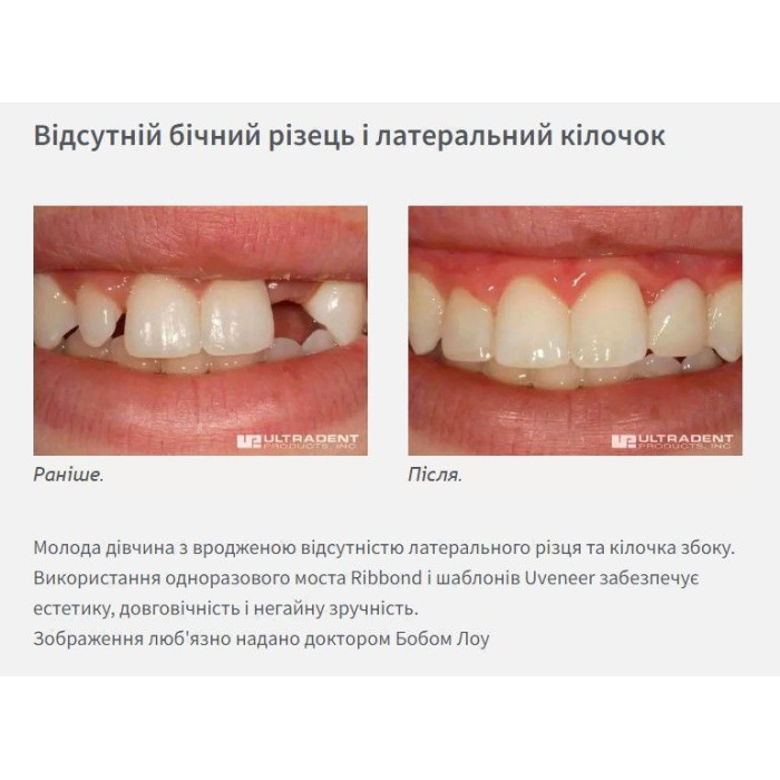 Uveneer (Ювенір) № UVKV3, Н-р: 4 х 8шт, (# ЗНЯТО З ВИРОБНИЦТВА  #) - Шаблони скловолоконні для виготовлення прямих композитних вінірів (Ultradent/Ультрадент)