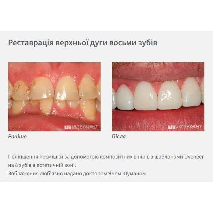 Uveneer (Ювенір) № UVKV3, Н-р: 4 х 8шт, (# ЗНЯТО З ВИРОБНИЦТВА  #) - Шаблони скловолоконні для виготовлення прямих композитних вінірів (Ultradent/Ультрадент)