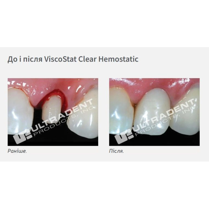 Viscostat Clear (Віскостат Клір) № 6408, шприц-диспенсер 30мл - Гемостатик-гель (хлорид алюмінію 25%) (Ultradent/Ультрадент)